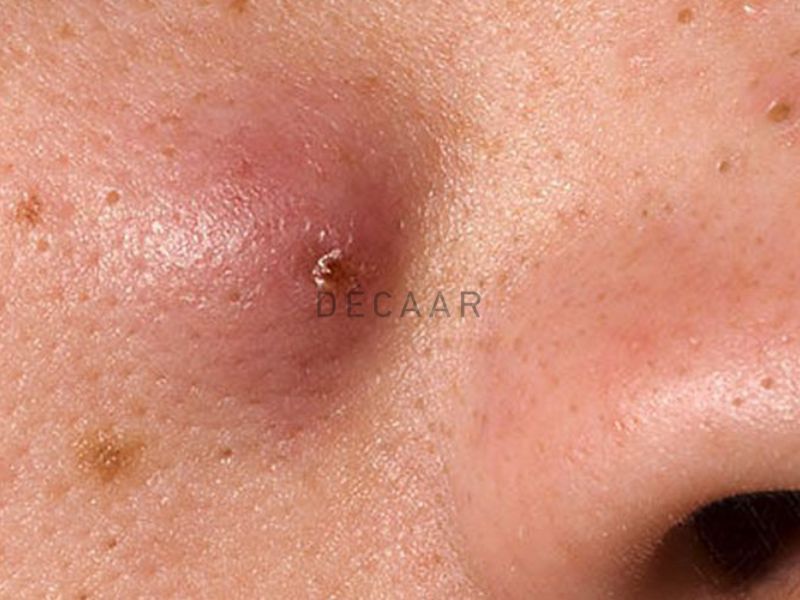 nguyên nhân mụn trứng cá bọc